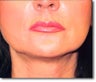 Restylane