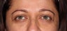 Undereye Filler Injection
