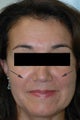 Restylane treatment for laugh lines  