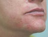 Chin rejuvenation 