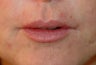 Restylane injections for upper lip lines 