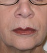 Restylane Treatment for Lips and Nasolabial Folds