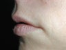 Restylane