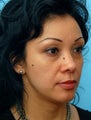 Restylane Treatment to the Eyes and Cheeks