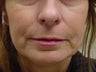 Restylane treatment for marionette lines 