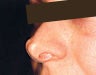 Restylane