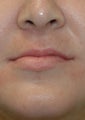 Lip Augmentation