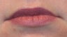 Restylane and botox used to augment the lips