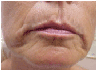 Restylane