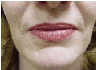 restylane 