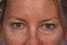 Restylane to Tear Trough (under eyes)