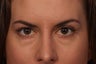Restylane to Tear Troughs (under eyes)