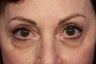 Restylane
