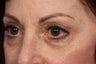 Restylane 