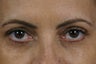 Restylane 