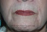 Dermal Filler Injection to Marionette and Accessory Smile Lines