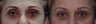 Upper eyelid filler with restylane