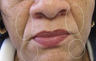 Restylane Injection Nasolabila folds