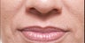 Restylane