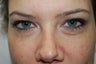 Restylane used in tear trough 