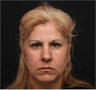 Juvederm