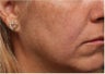 Restylane