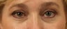Lower Eyelid/Tear-Trough Restyalne