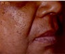 Restylane/Juvederm