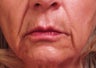 Restylane