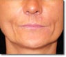 Restylane