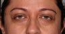 Undereye Filler Injection