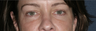 Restylane