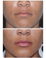 Restylane