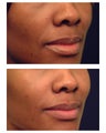 Restylane