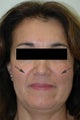 Restylane treatment for laugh lines  