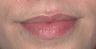 Lip Augmentation