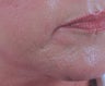Chin rejuvenation 