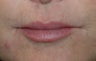 Restylane injections for upper lip lines 
