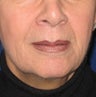 Restylane Treatment for Lips and Nasolabial Folds