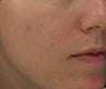 Hyperpigmentation treated with Obagi for 3 months