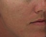 Hyperpigmentation treated with Obagi for 3 months