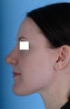 Revision Rhinoplasty 