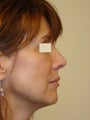 Revision Rhinoplasty