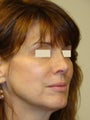 Revision Rhinoplasty