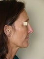 Reconstructive rhinoplasty