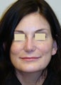 Reconstructive Secondary Rhinoplasty with Chin Implant