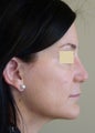 Reconstructive Secondary Rhinoplasty  with Chin Implant