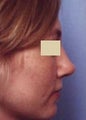 Rhinoplasty revision