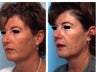 Rhinoplasty revision