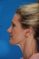 Revision Rhinoplasty